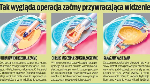 Этот метод борьбы с катарактой является факоэмульсификацией